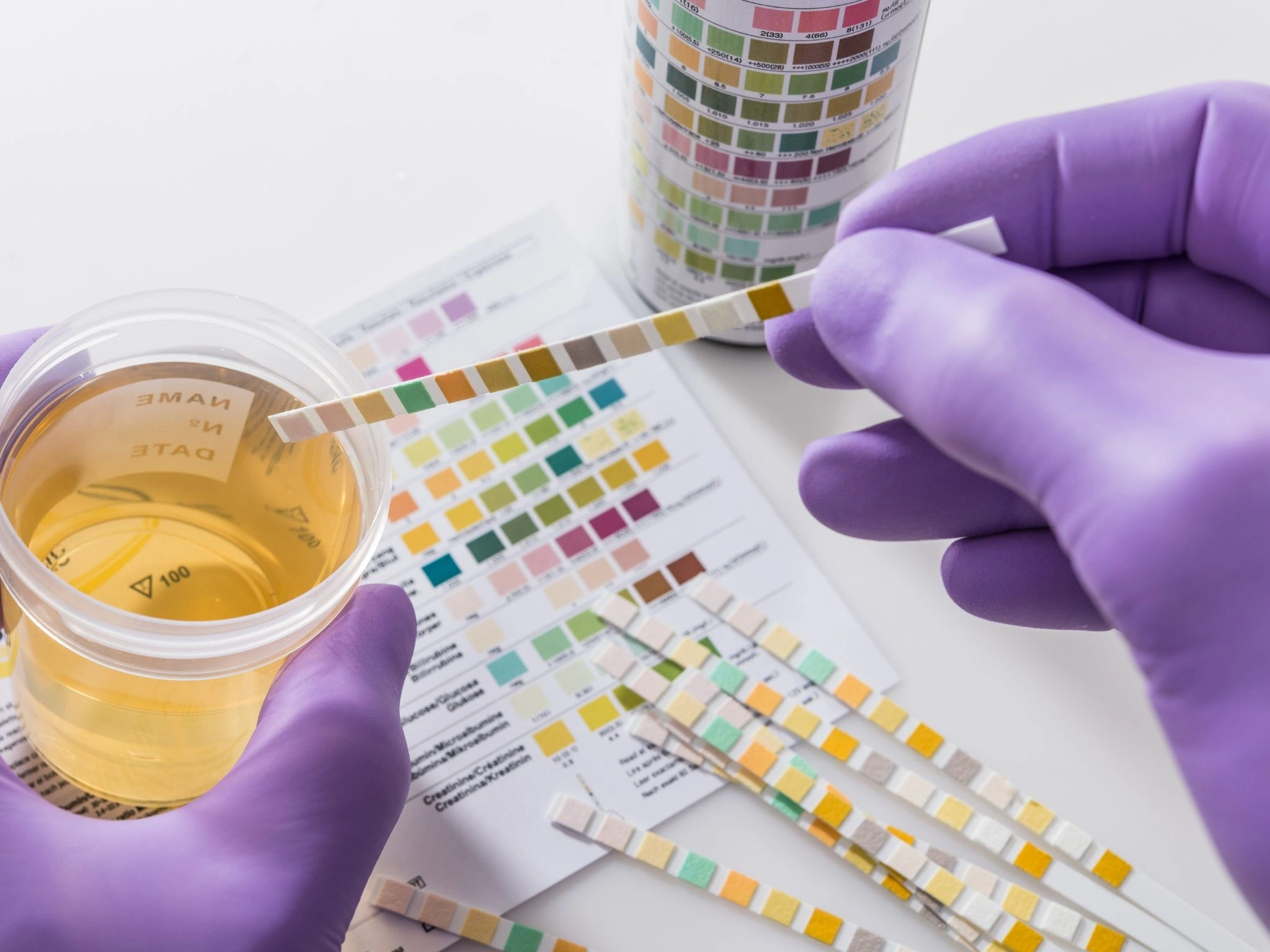 Leukozyten im Urin: Diagnostik und klinische Konsequenzen