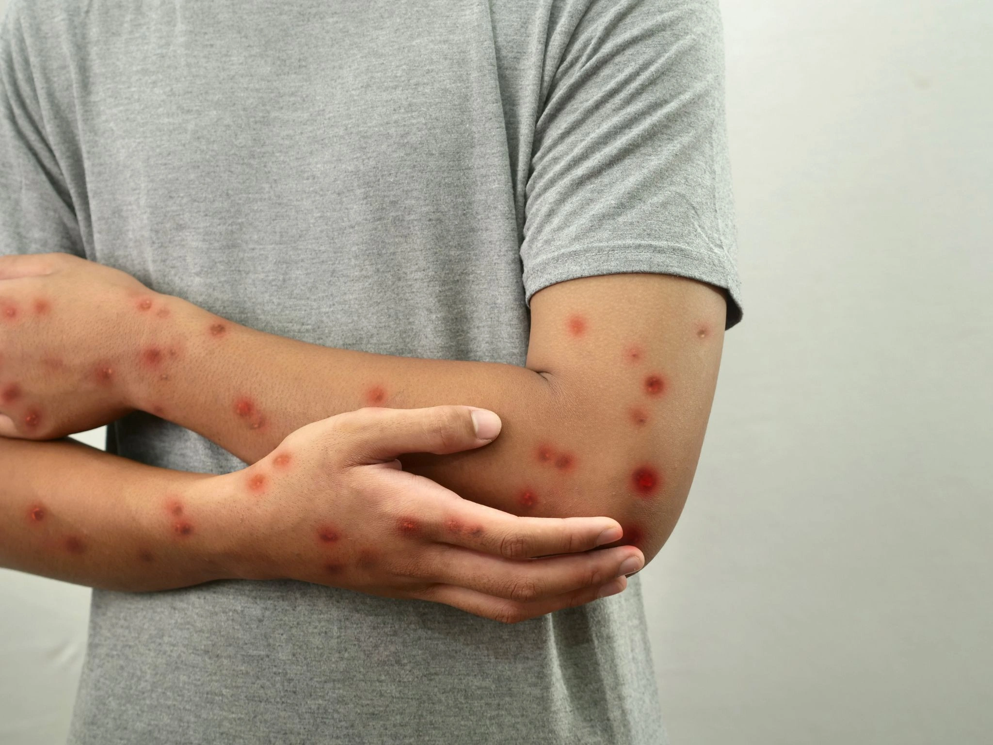 Mpox-PCR: Point-of-Care-Diagnostik für Klinik und Praxis