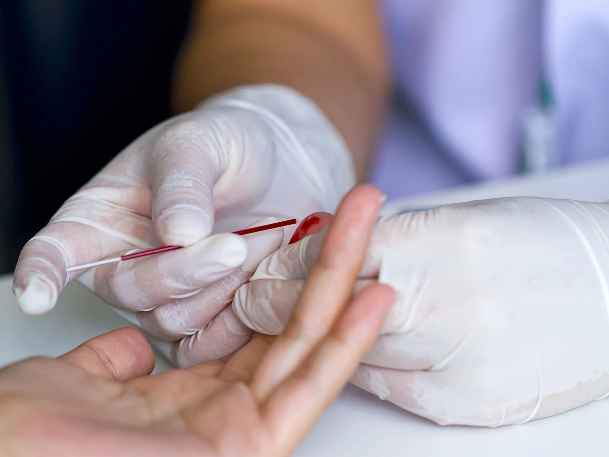 Kapilläre BGA: Bedeutung und Nutzen in der klinischen Praxis